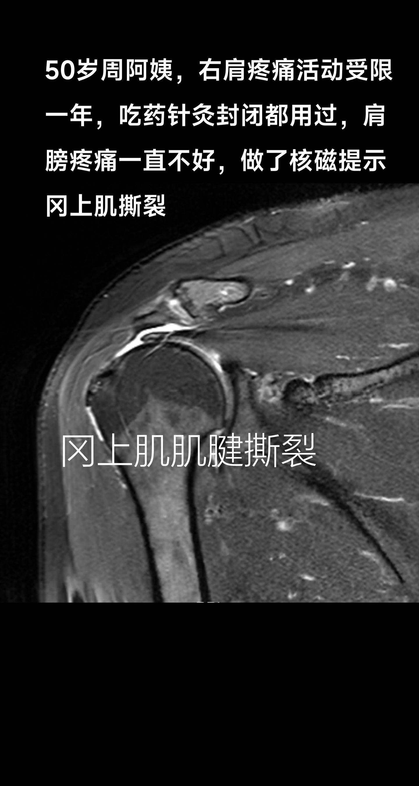肩袖撕裂治疗。