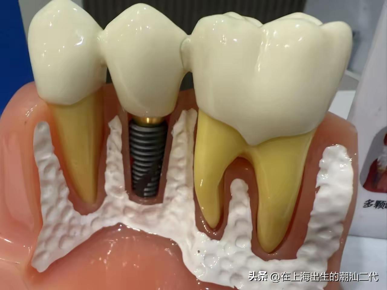 在美国看牙医很贵，吃高糖甜食对牙齿不好，但是美国又是一个高糖甜食的国度。这样的恶