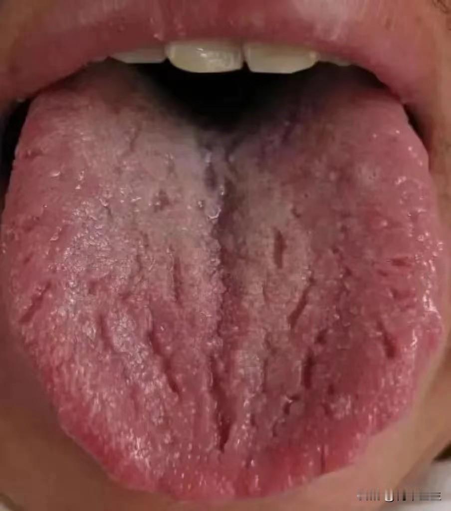 舌面裂纹这么深，就长点心吧，这个粉丝才二十多的年纪，肾精就亏成这样了

患者主诉