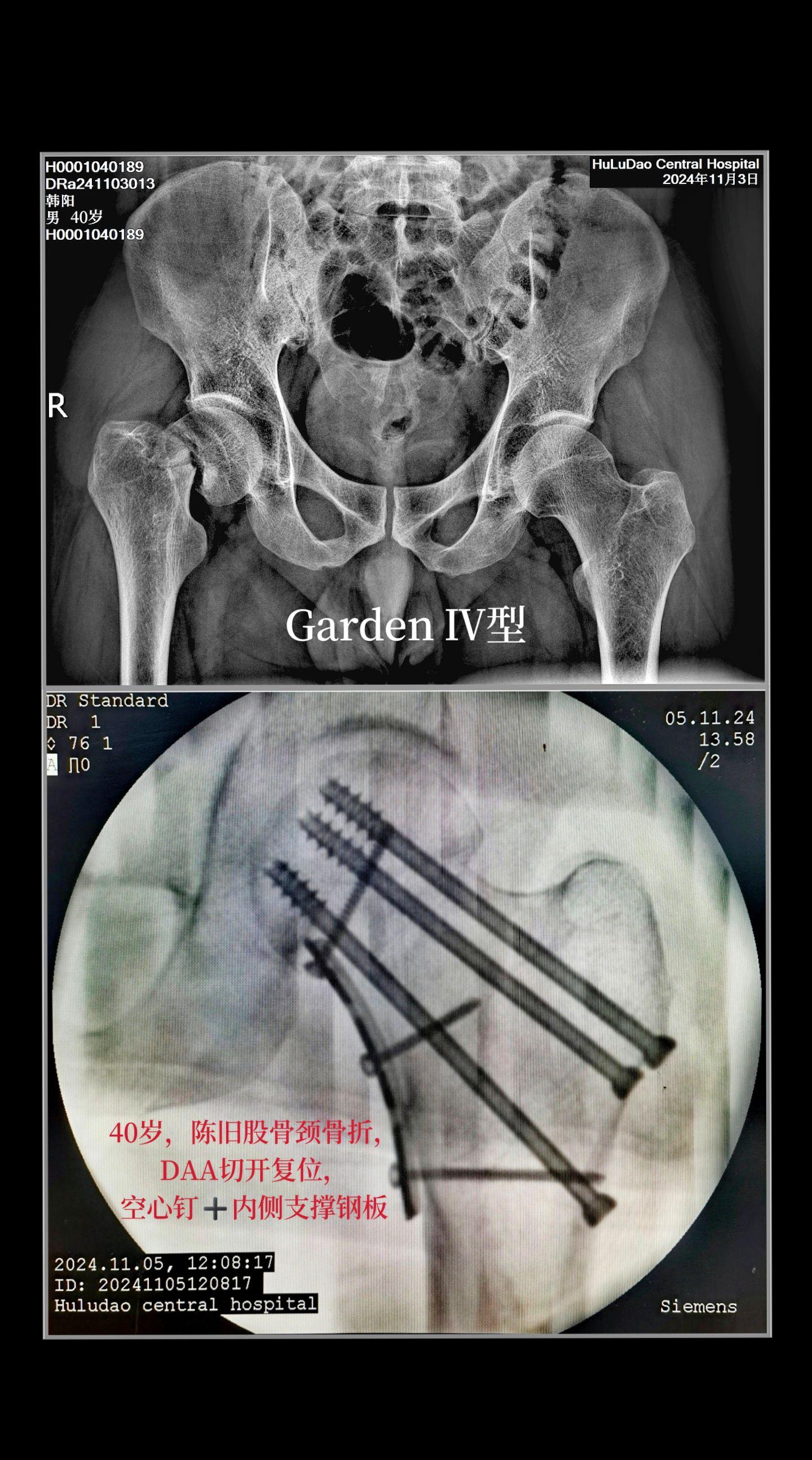 40岁男患，陈旧性股骨颈骨折(Garden Ⅳ型)，经DAA入路手术切...
