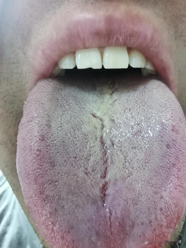 舌头一旦出现裂纹，千万不要不当一回事[吃瓜群众][吃瓜群众][吃瓜群众]
门诊患
