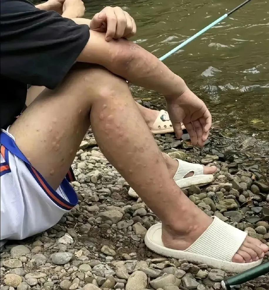 刷到个钓鱼佬的图给我笑惨了，又觉得怪心疼。瞅瞅这腿和胳膊，密密麻麻全是蚊子包，简