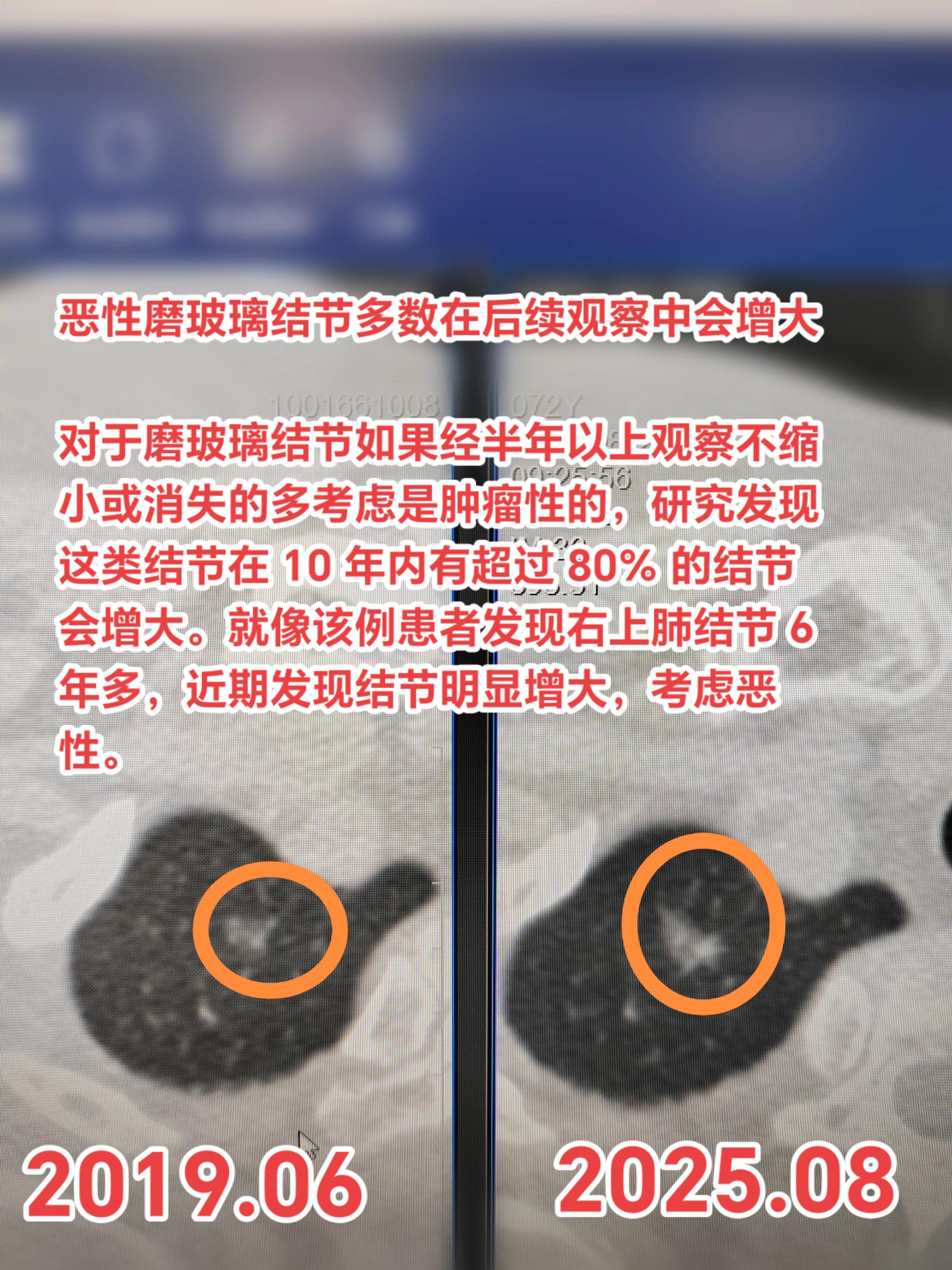 恶性磨玻璃结节多数在后续观察中会增大！对于磨玻璃结节如果经半年以上观察...