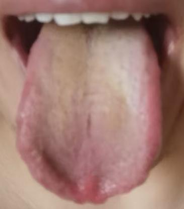 周身脉络瘀滞，气血难达宗筋，分享破瘀和络调养思路






很多人出现了海绵体