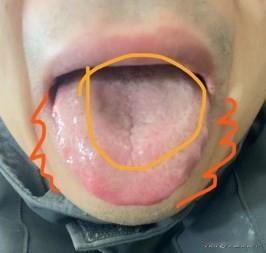舌诊实战分享：
脾胃虚弱—中焦凹陷明显，平时可能腹胀腹痛，容易消化不良
肝胆湿热