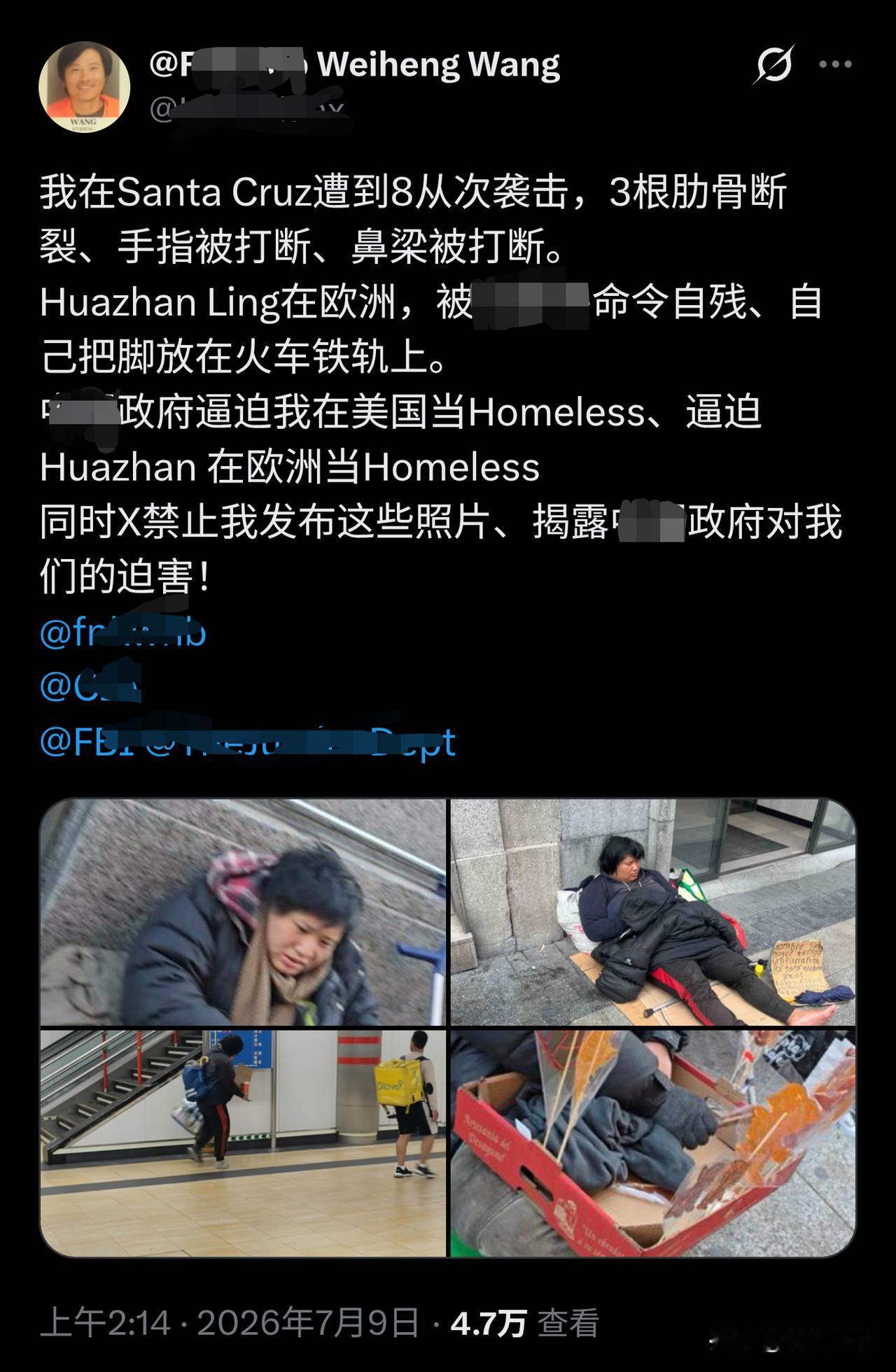 “甜甜圈”王伟恒又发文了，这次是晒他受的伤。

他说在美国遭了8次袭击，肋骨、手