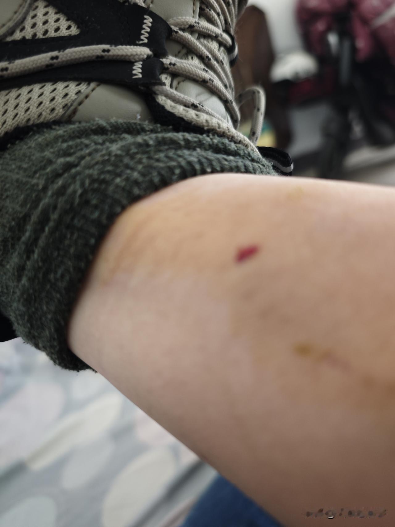 被狗咬了，真窝火啊！
刚才去找一个朋友，他租的房子是一个城中村的院子，院子里有三