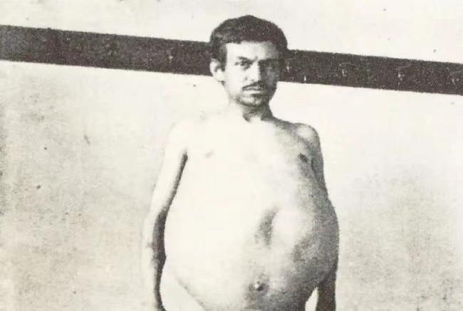 1940年，美国人约翰由于便秘，三年没排泄，不幸去世，医生检查发现，他体内竟堆积