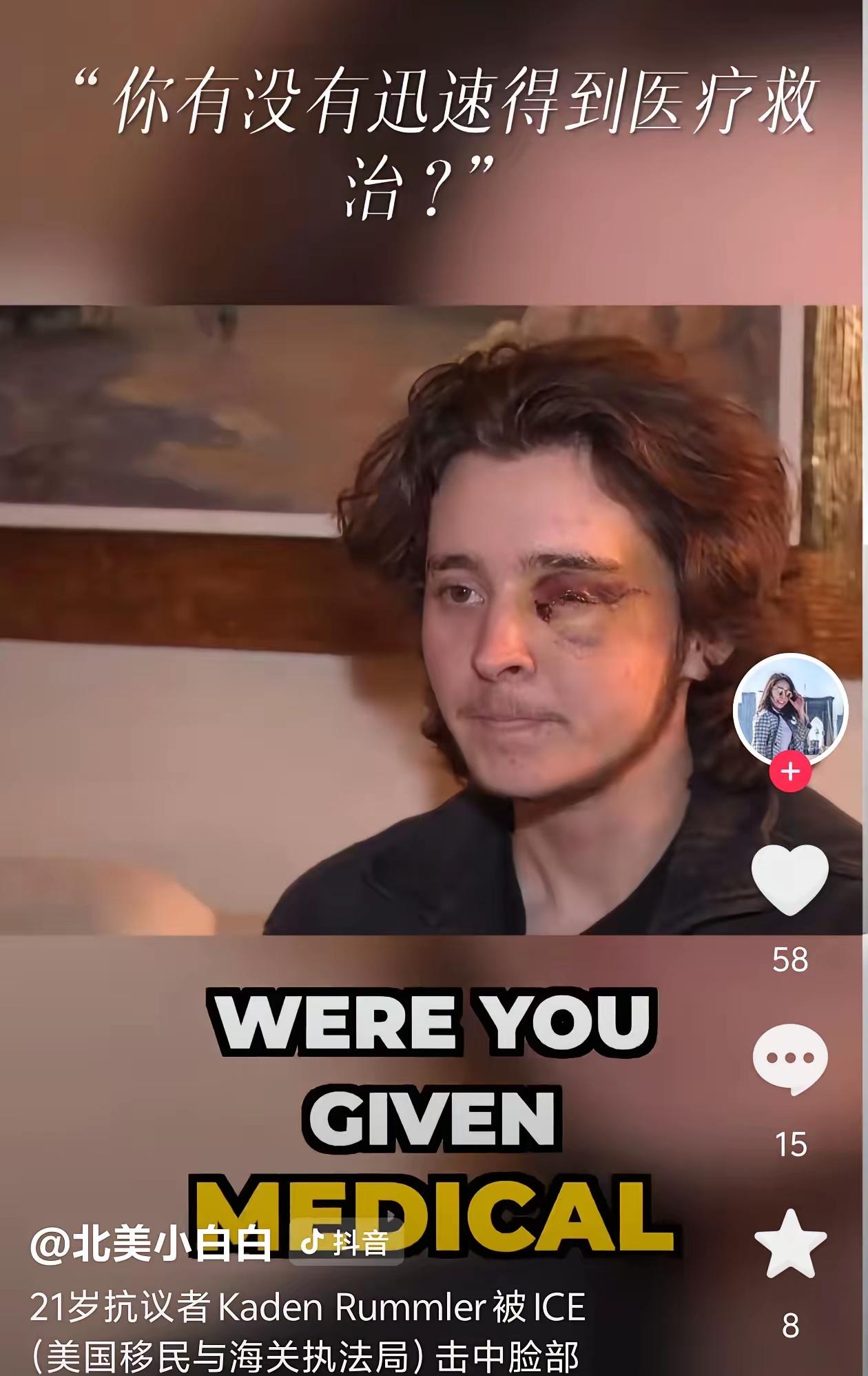 美国21岁女大学生安姆拉最近参加抗议活动，被美国ICE特工将左眼睛打瞎了，她没有