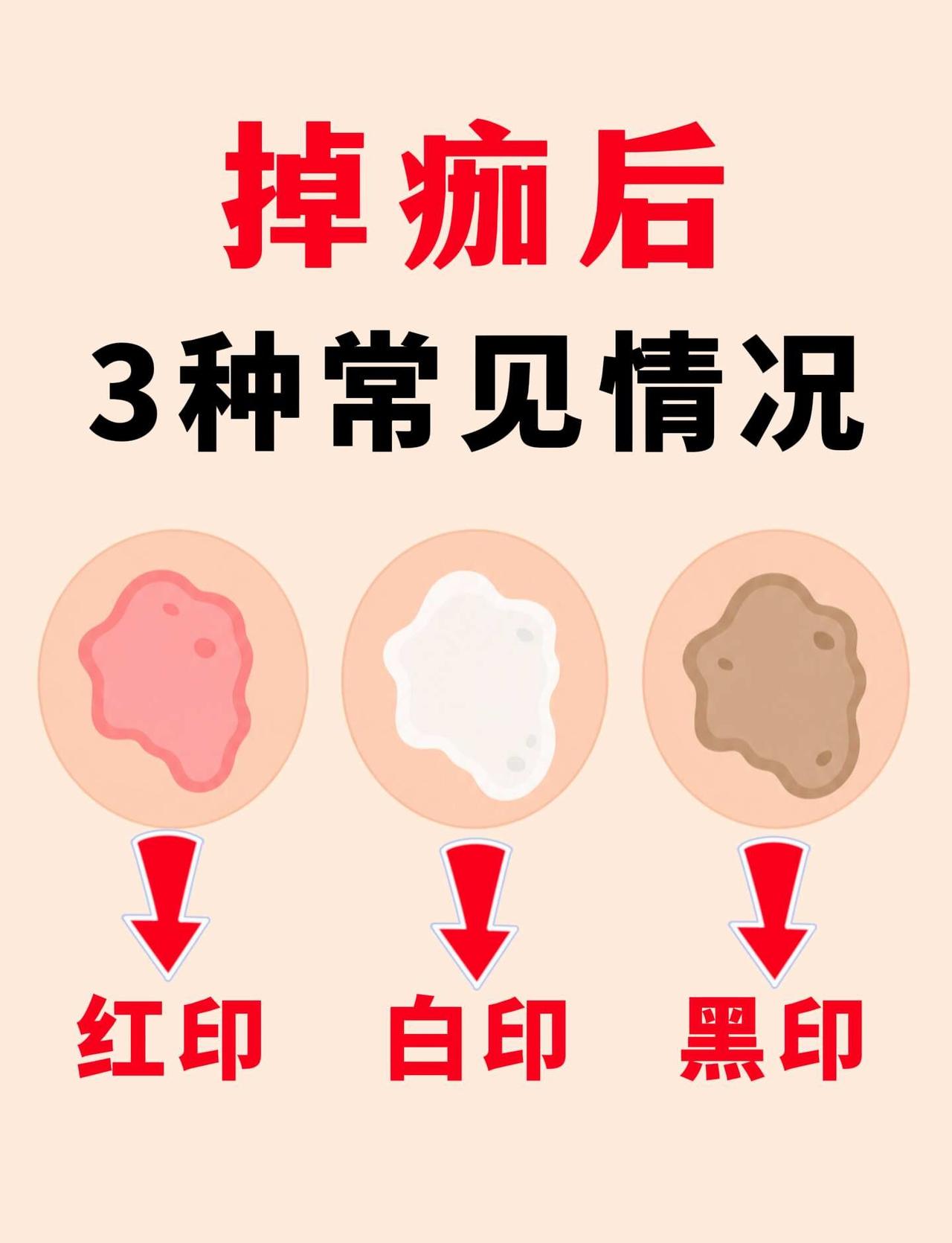 掉痂后，红印/白印/黑印，如何护理淡化？
👀很多人以为伤口结痂掉了就万事大吉？