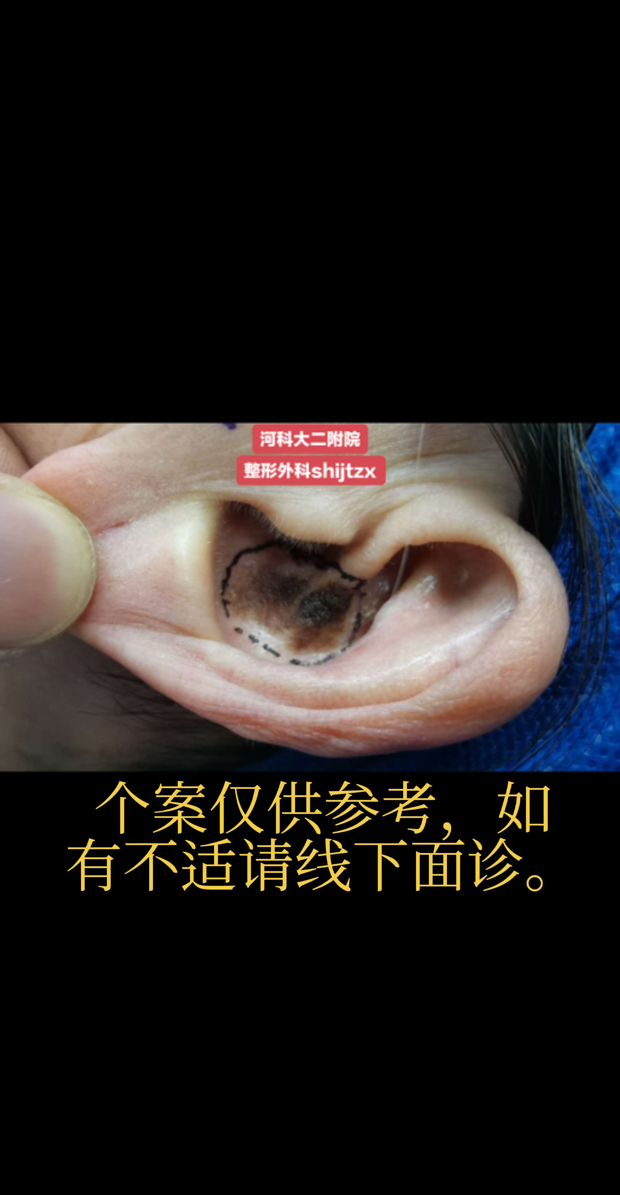 耳廓皮肤肿物。