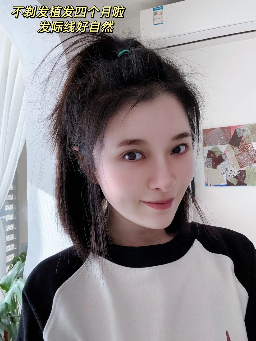 植发四个月，超喜欢现在的发际线