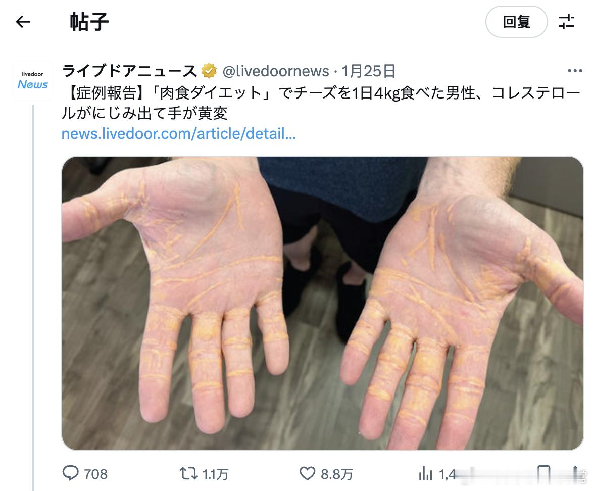 【一名美国男性每天食用4公斤奶酪，体内的胆固醇渗出，导致手部变黄】有一名美国男性