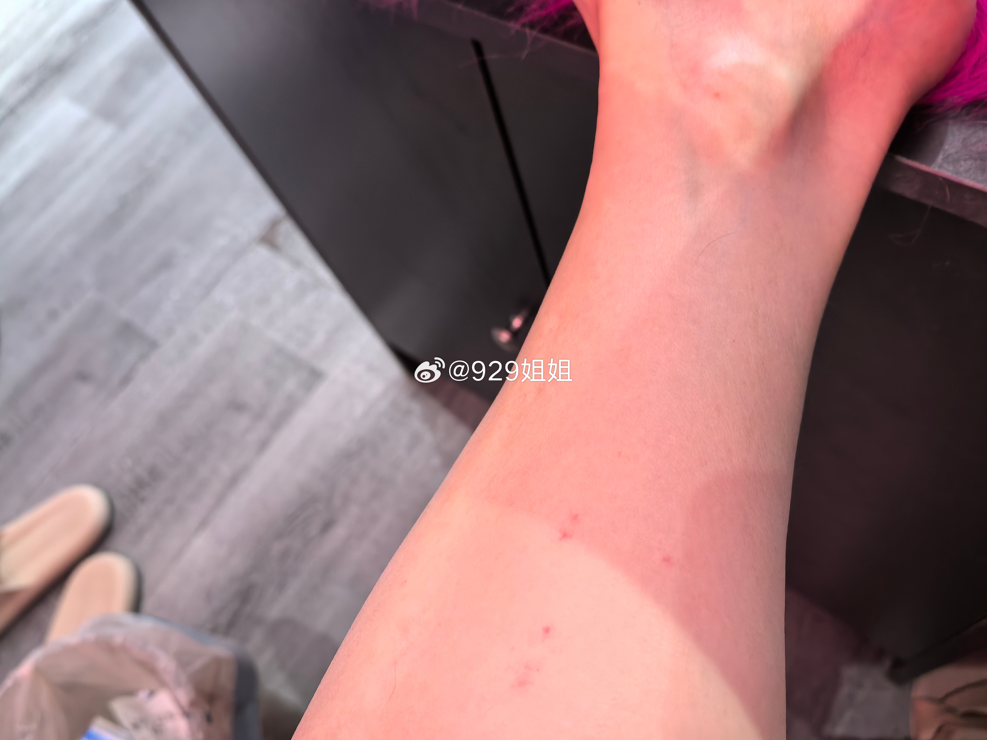 昨晚哪个公蚊子偷偷咬了我我还穿了裤子呢[哼] ​​​