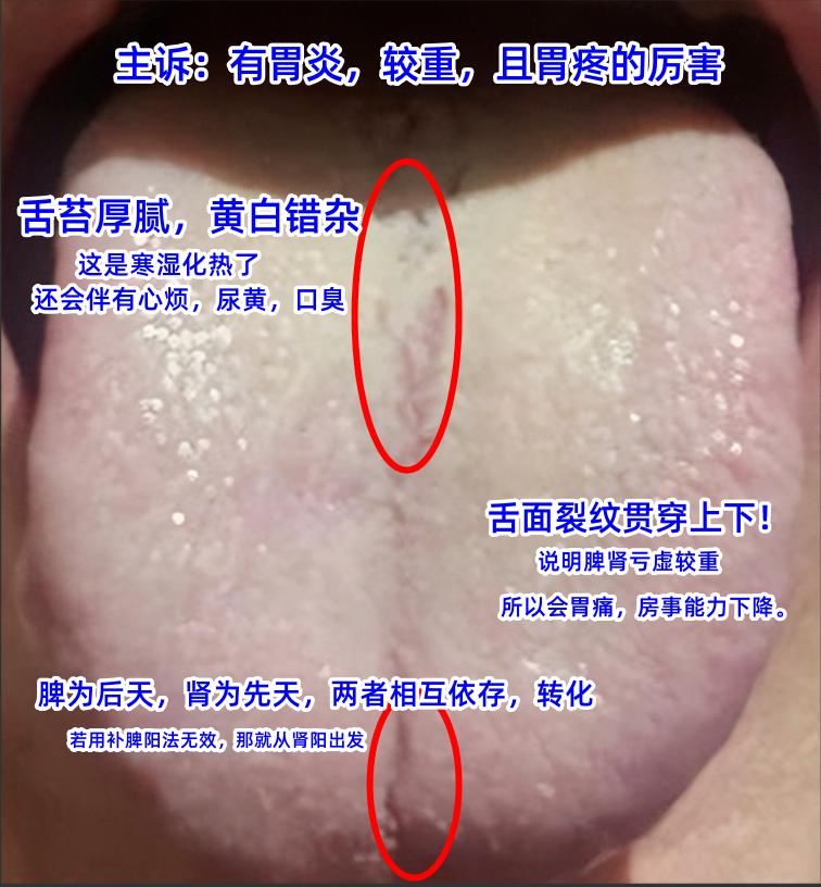 今日舌诊案例分析：心肝火旺，中气不足，脾胃湿热，痰湿积食[给力][给力][给力]