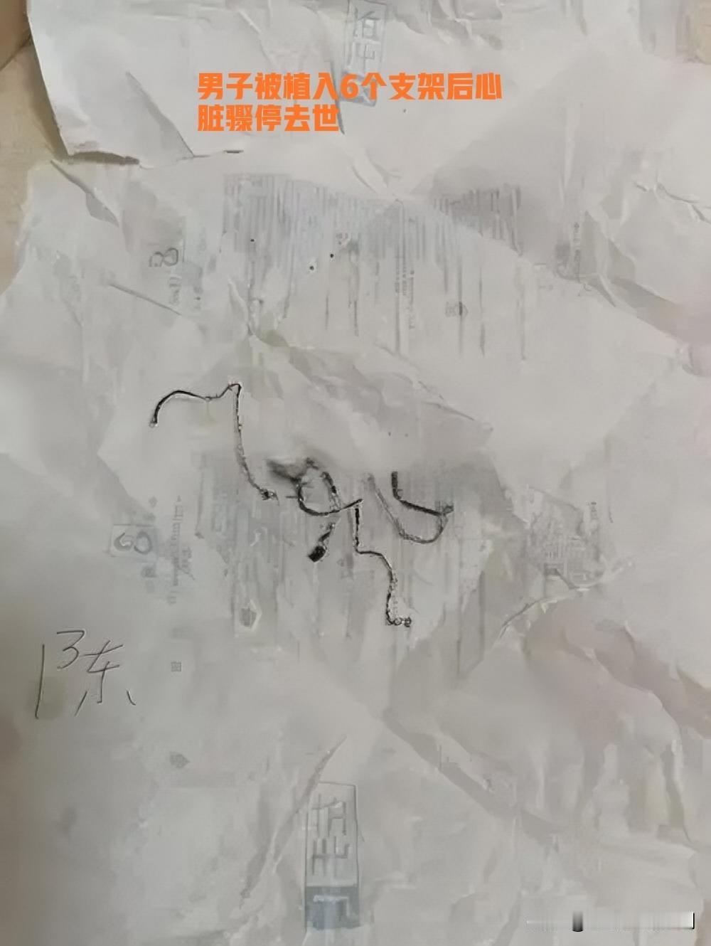 2025年7月26日，吉林舒兰市42岁男子陈先生在舒兰市人民医院，被一次性植入6