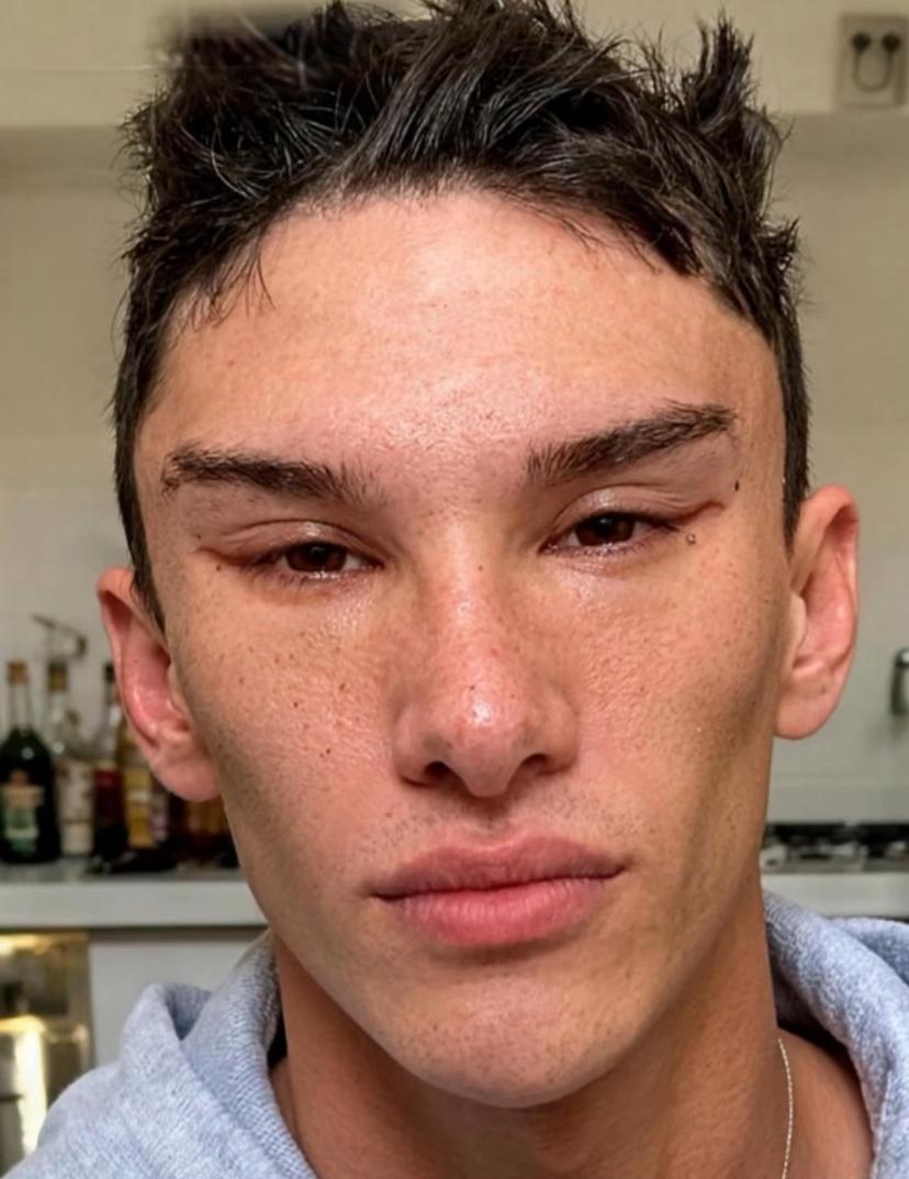 最近美国男网红去拉皮了，做了眼角局部拉皮手术，效果很成功，整个脸都提上去了。​​