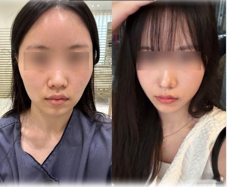 只做了颧骨 