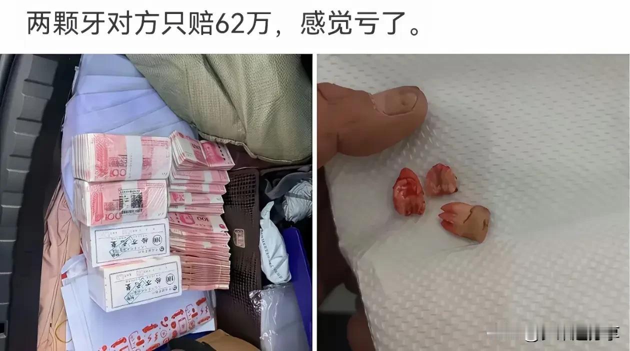 两颗牙对方赔了62万，感觉自己亏了！

我想对折出两颗，不知道有没有人买？

那