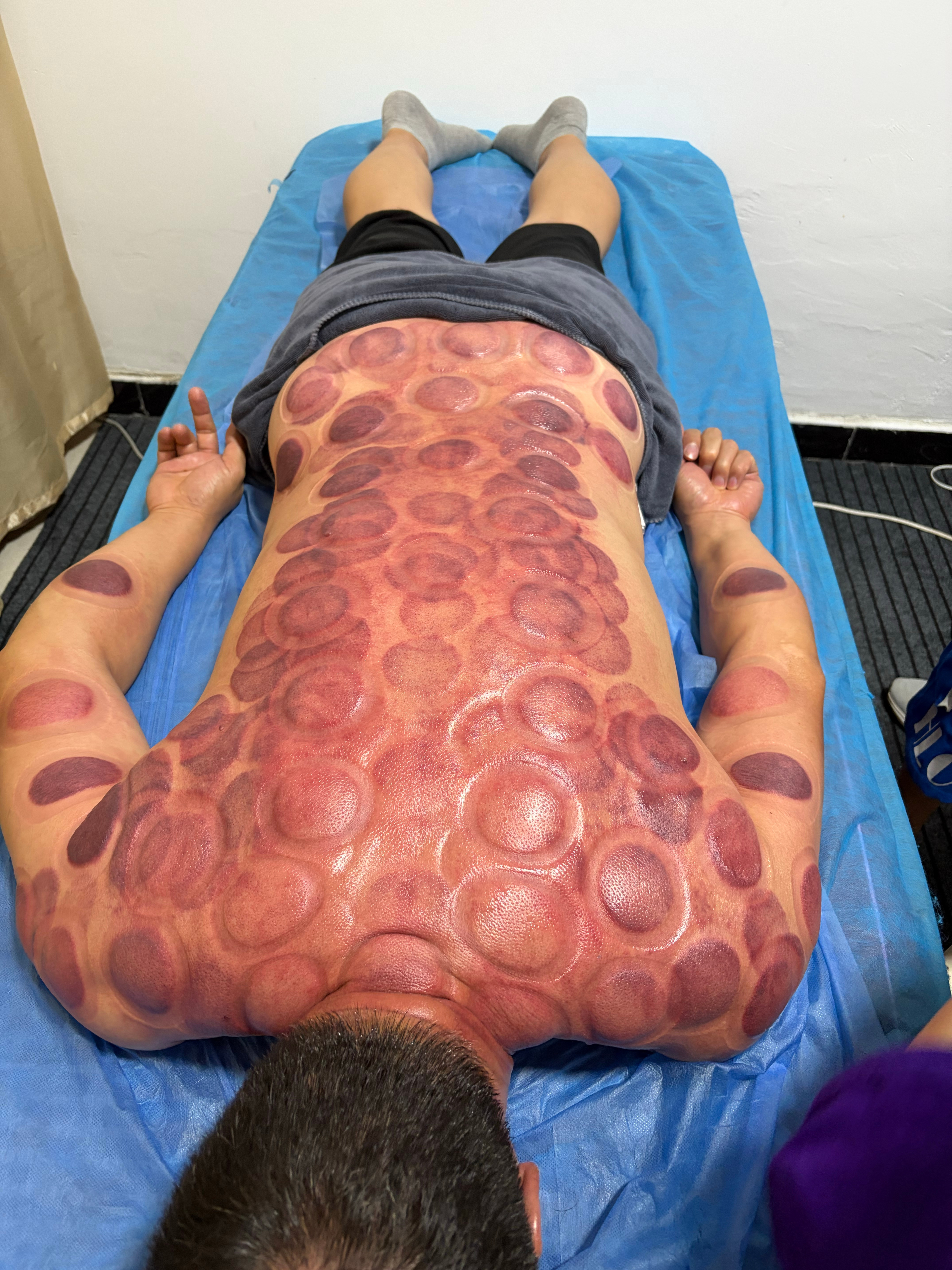 看一个人心力如何，做一下刮痧拔罐就知道了：心力强的人去刮痧拔罐，皮肤都是火红一片