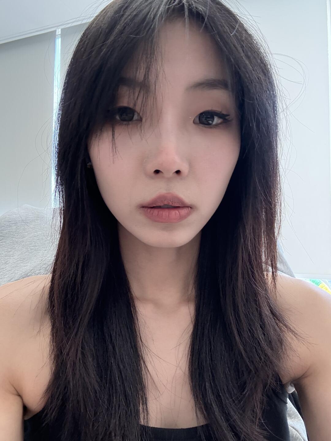脸部凹陷填充前后