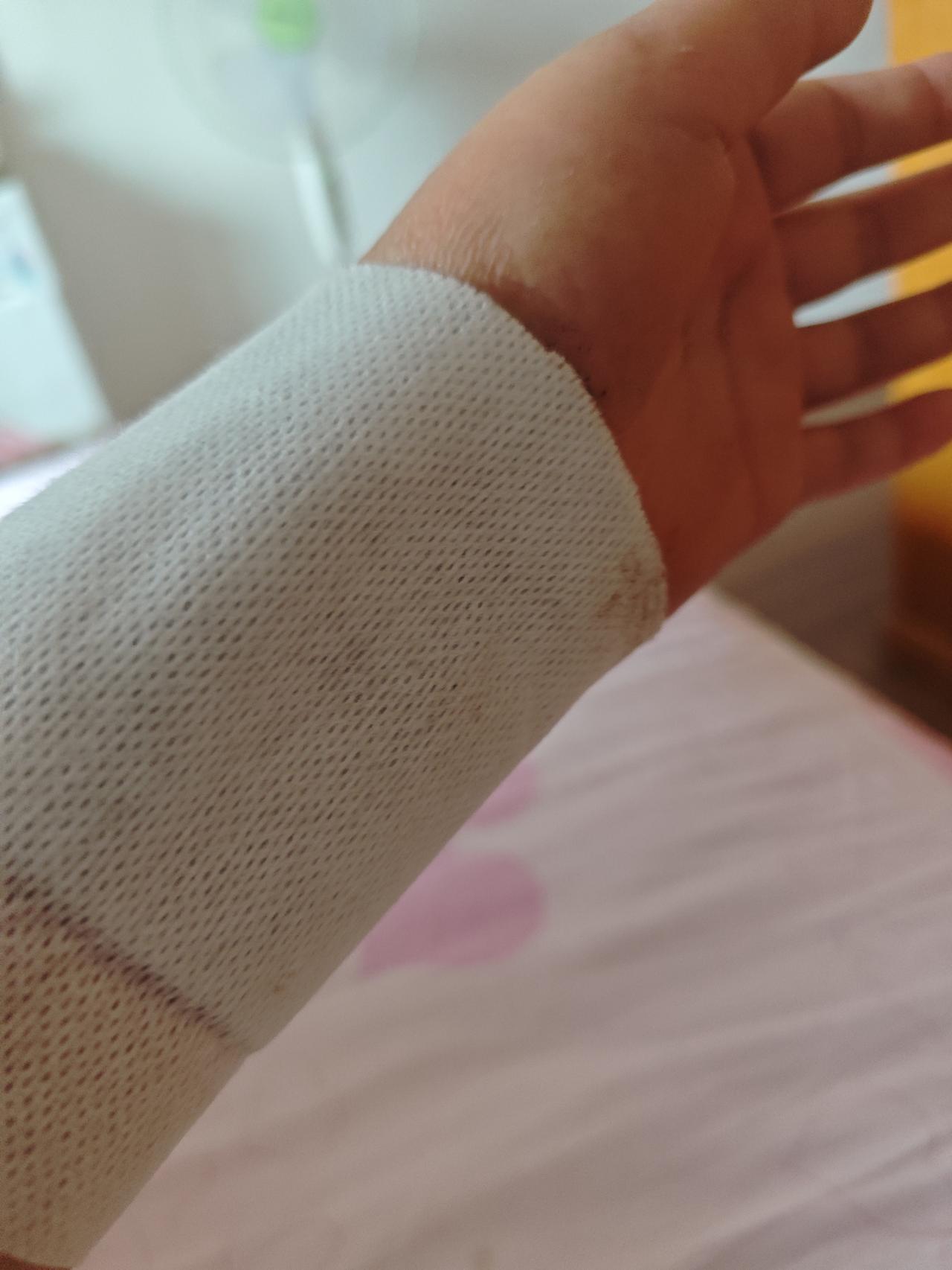 今天是6.19日，也是出车祸整整两个月的日子，看看自己的手依然还有点肿，真是愁人