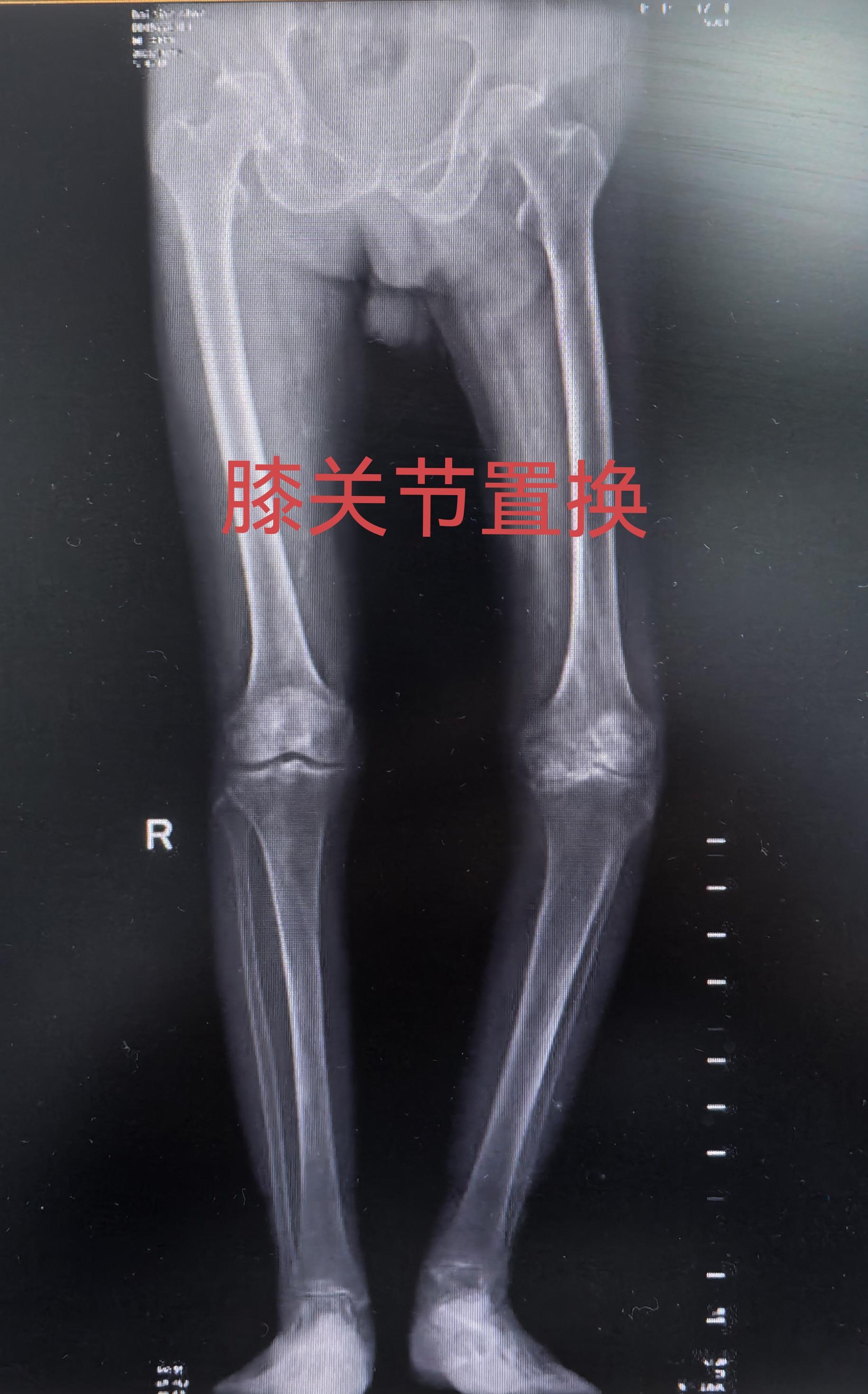 膝关节置换TKA.受罪多年的85岁老爷子，终于下定了决心。其实骨性关节...
