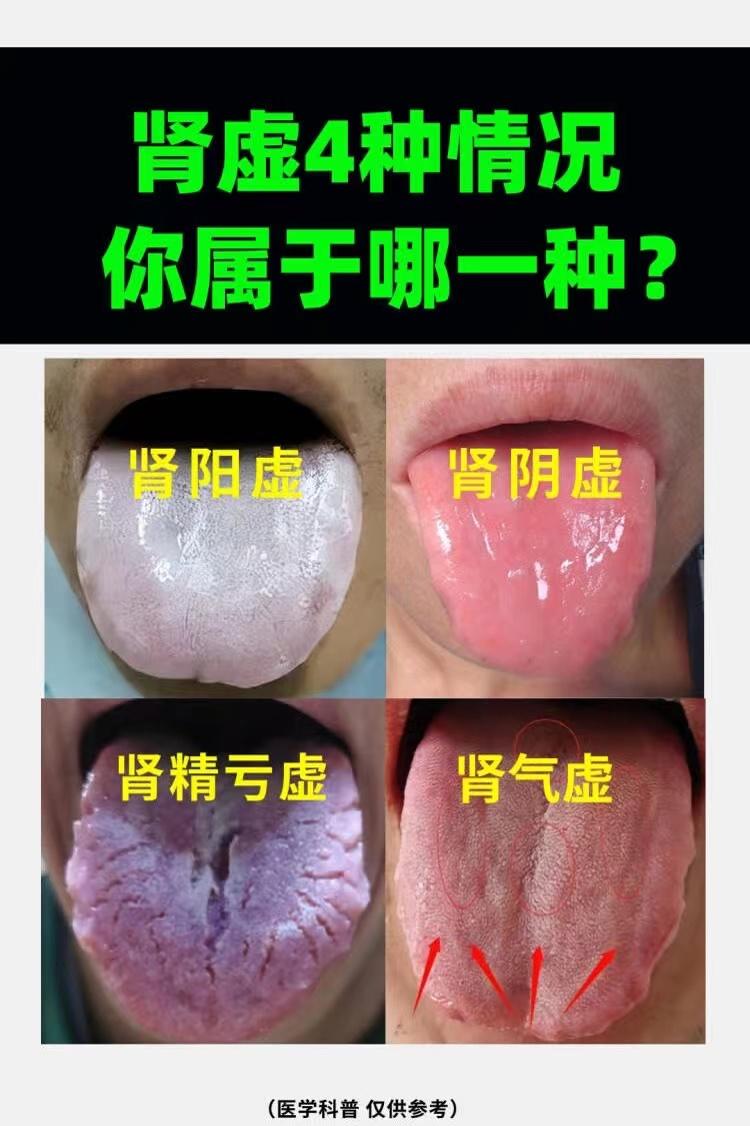 肾虚4种情况你属于哪一种？
如图所示（图1）
1、舌头发红，无苔或少苔-——肾阴