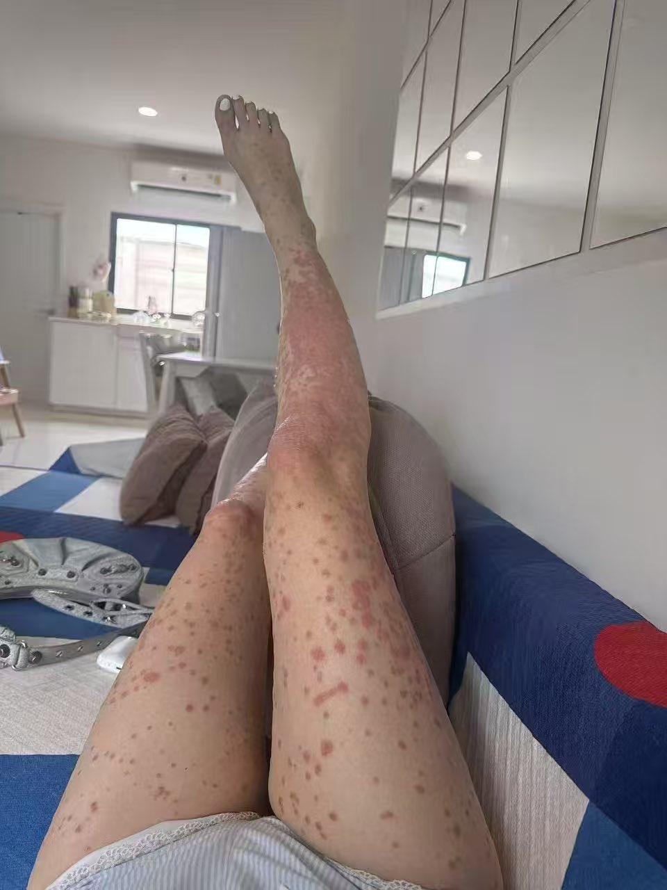 为什么有人误以为“黑人不发病”？

非洲艾滋病流行严重，但很多人活得久。不是“不