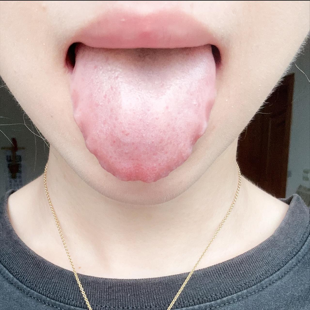 一招教你辨舌苔，身体出问题，全藏在舌苔❗️❗️❗️
①淤斑舌
大多为女性，月经不
