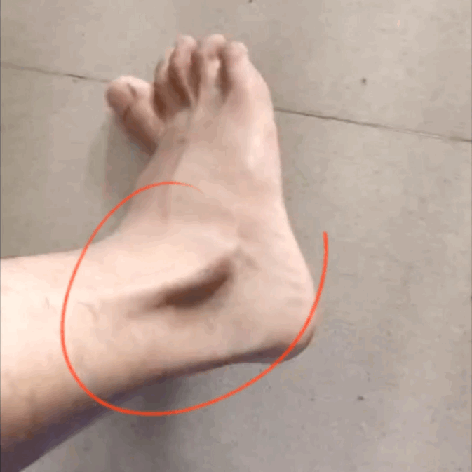 弹响 今天继续讲讲，一种常见的脚踝弹响——腓骨肌腱滑脱，也就是转动脚踝的时候，脚