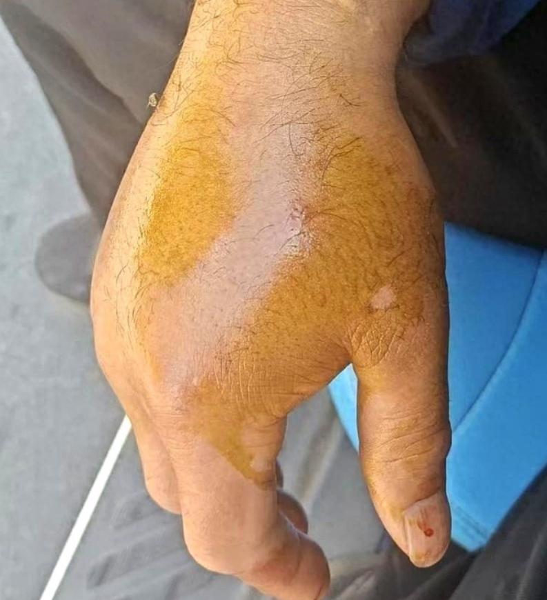 5月15日长江新闻报道，云南昭通一村民挥锄砍断一条2米长的眼镜王蛇后，随手甩掉泥
