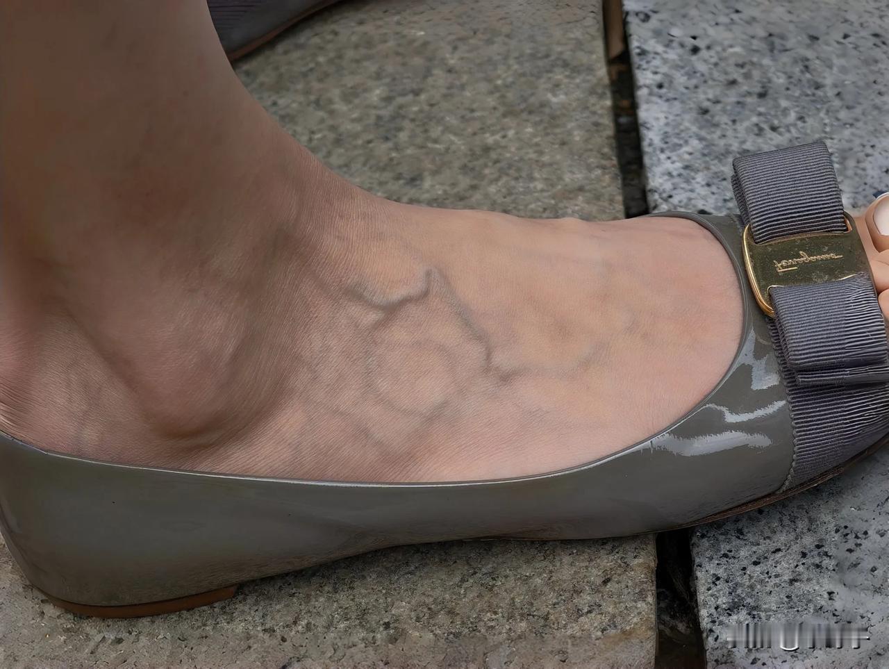 女的脚上这么多青筋正常吗？是不是穿高跟鞋穿的呢