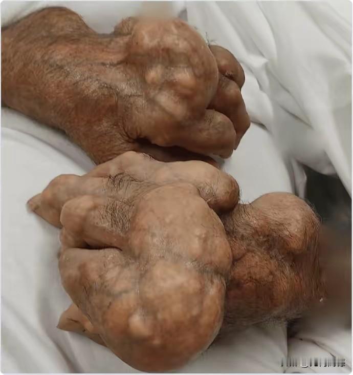 这手完全都已经变形了，这病人得遭受多大的痛苦啊，类似于这样的痛风病人，这手无论怎