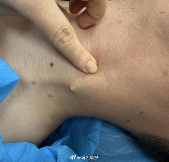 【#硬吞饭团把鱼刺扎进颈部皮下#】#鱼刺卡喉第一时间如何处理#5月27日，据患者