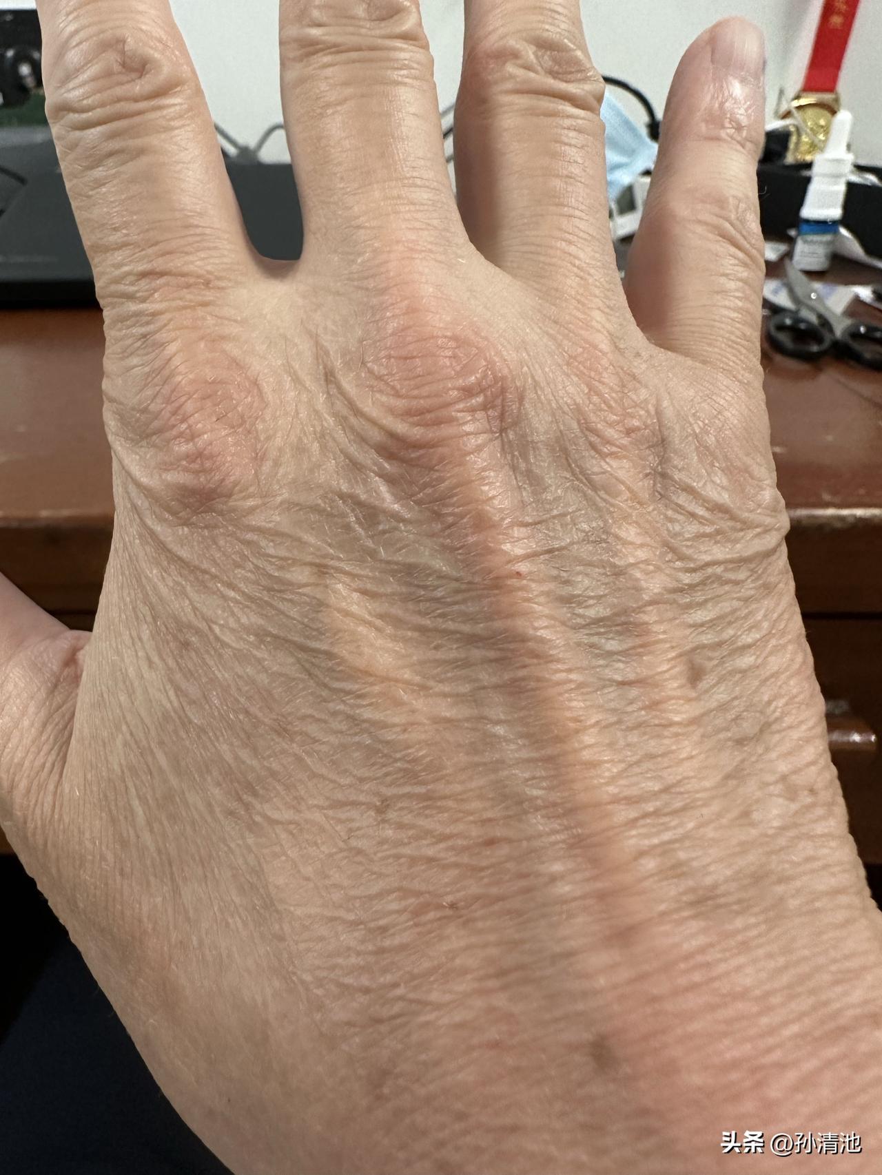 有一年做个小手术，手术前需要输液，护士输液只往一只手上扎，大家觉得护士喜欢扎哪只