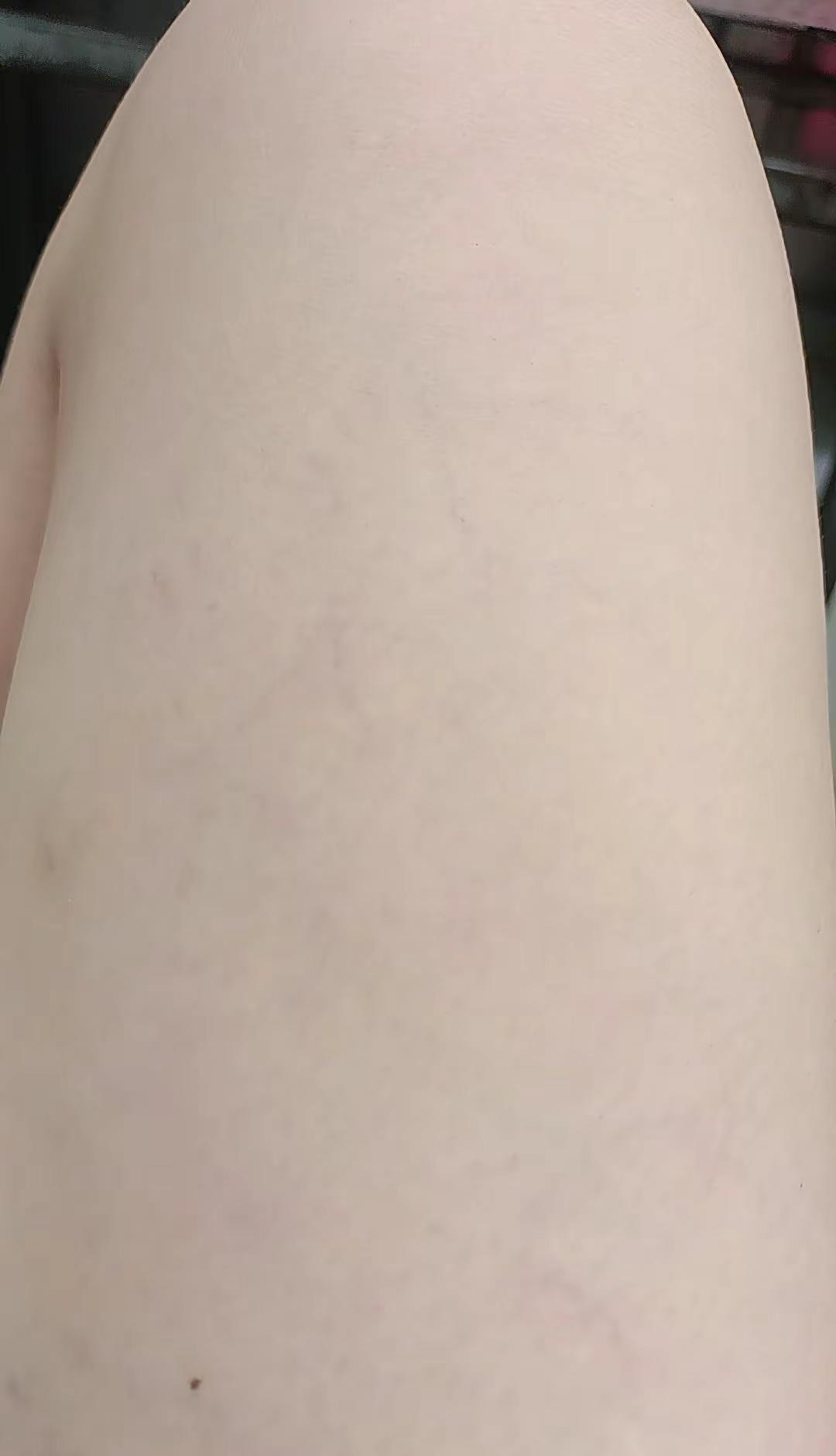 焦虑啊！怎么能不焦虑呢，怎么会不累呀，静脉曲张都出来了，小腿肚酸胀，有时候还抽筋