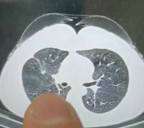 肺多发磨玻璃结节，大的切了，小的还要治吗？临床上经常遇到多发肺磨玻璃结节的患者，