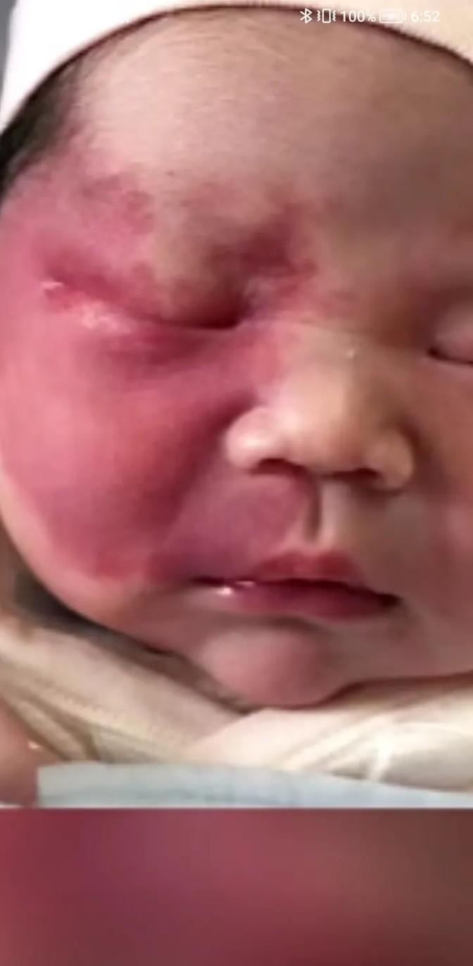 孩子出生了，可宝宝爸妈却愁眉苦脸的。原来小家伙脸上有一块明显的红胎记，看着挺显眼