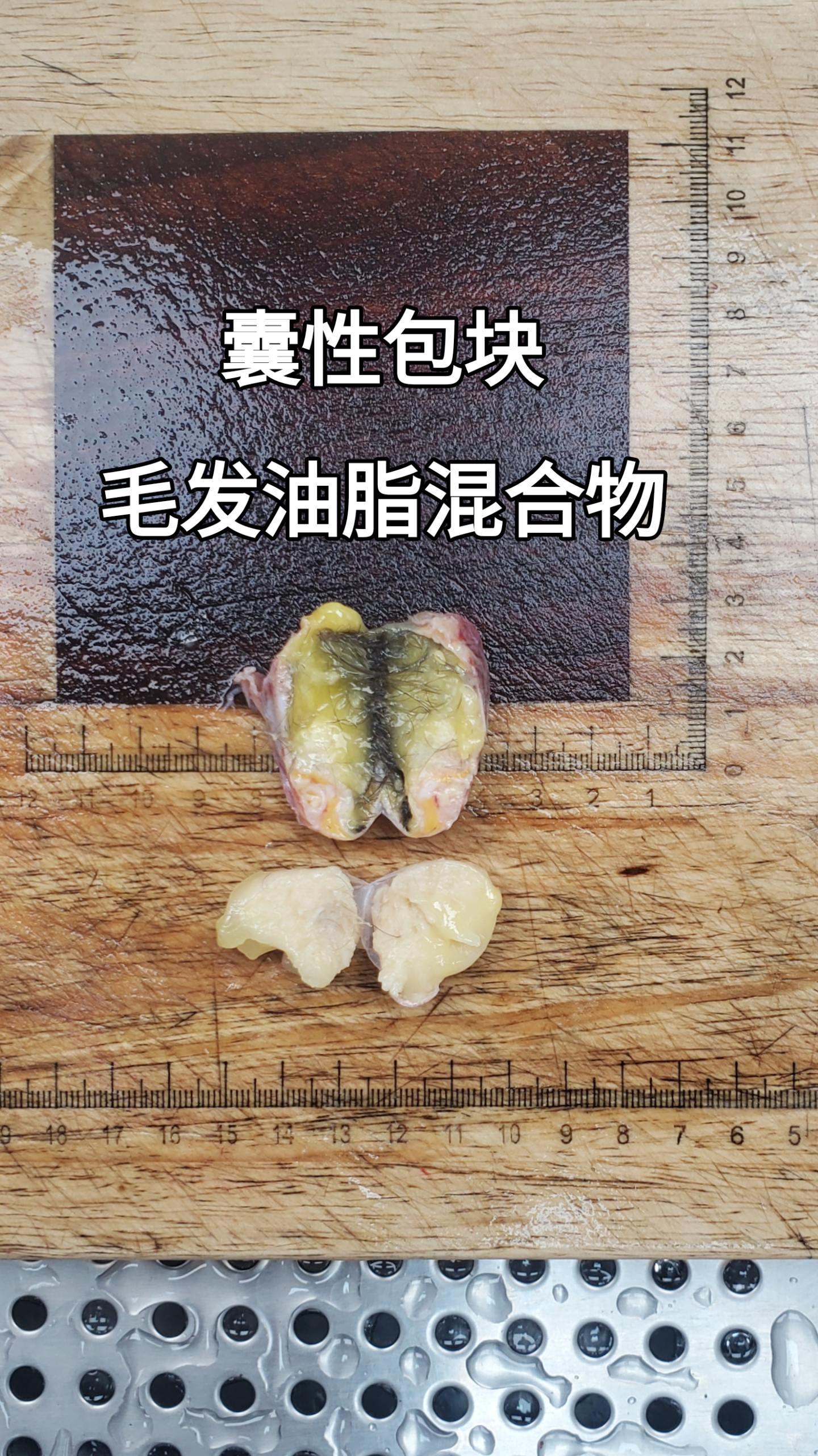 卵巢囊肿
