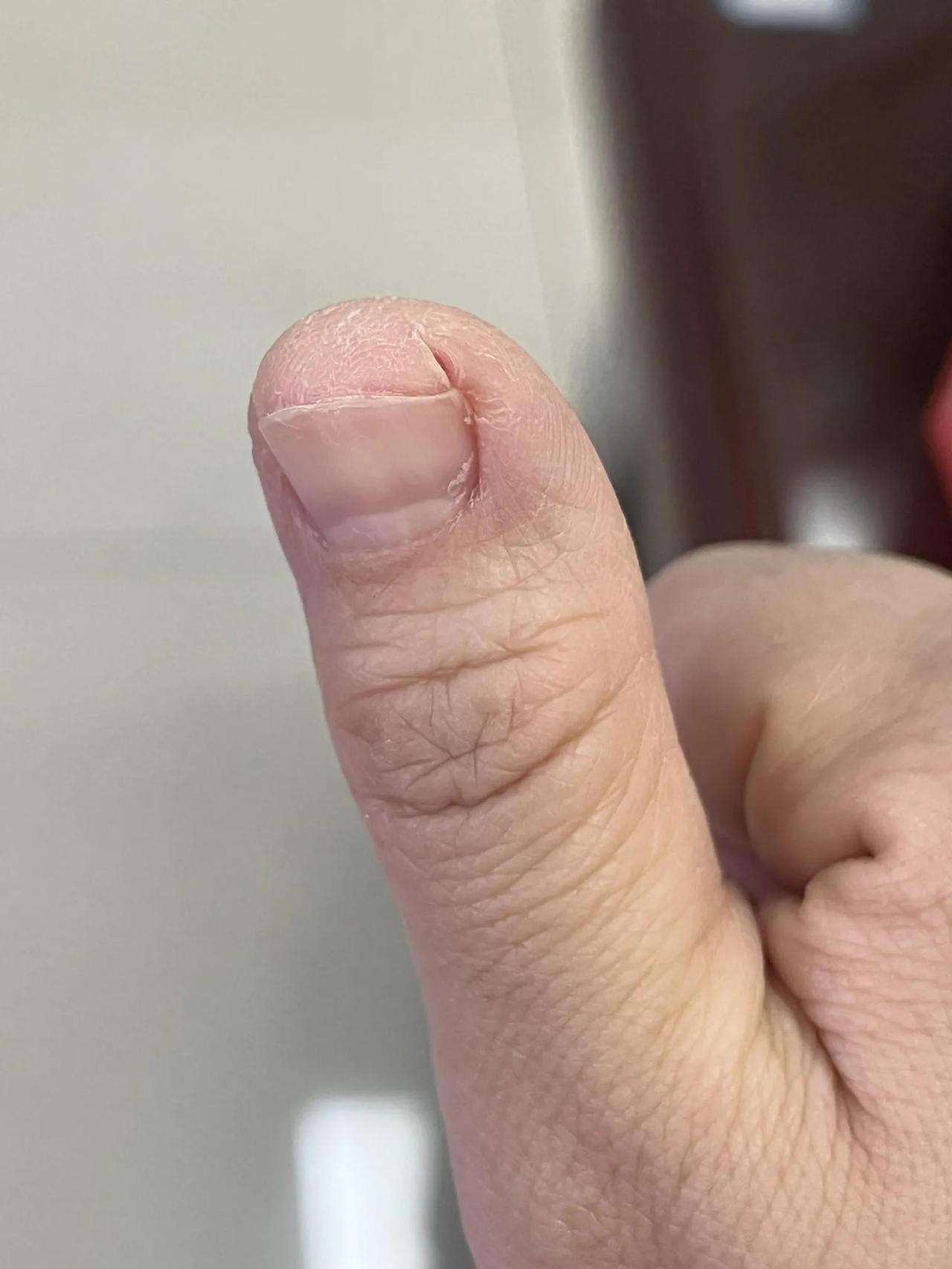 一到冬天手指裂开，有什么解救办法
每到冬天大拇指指甲两侧就裂开，两个手指都是这样