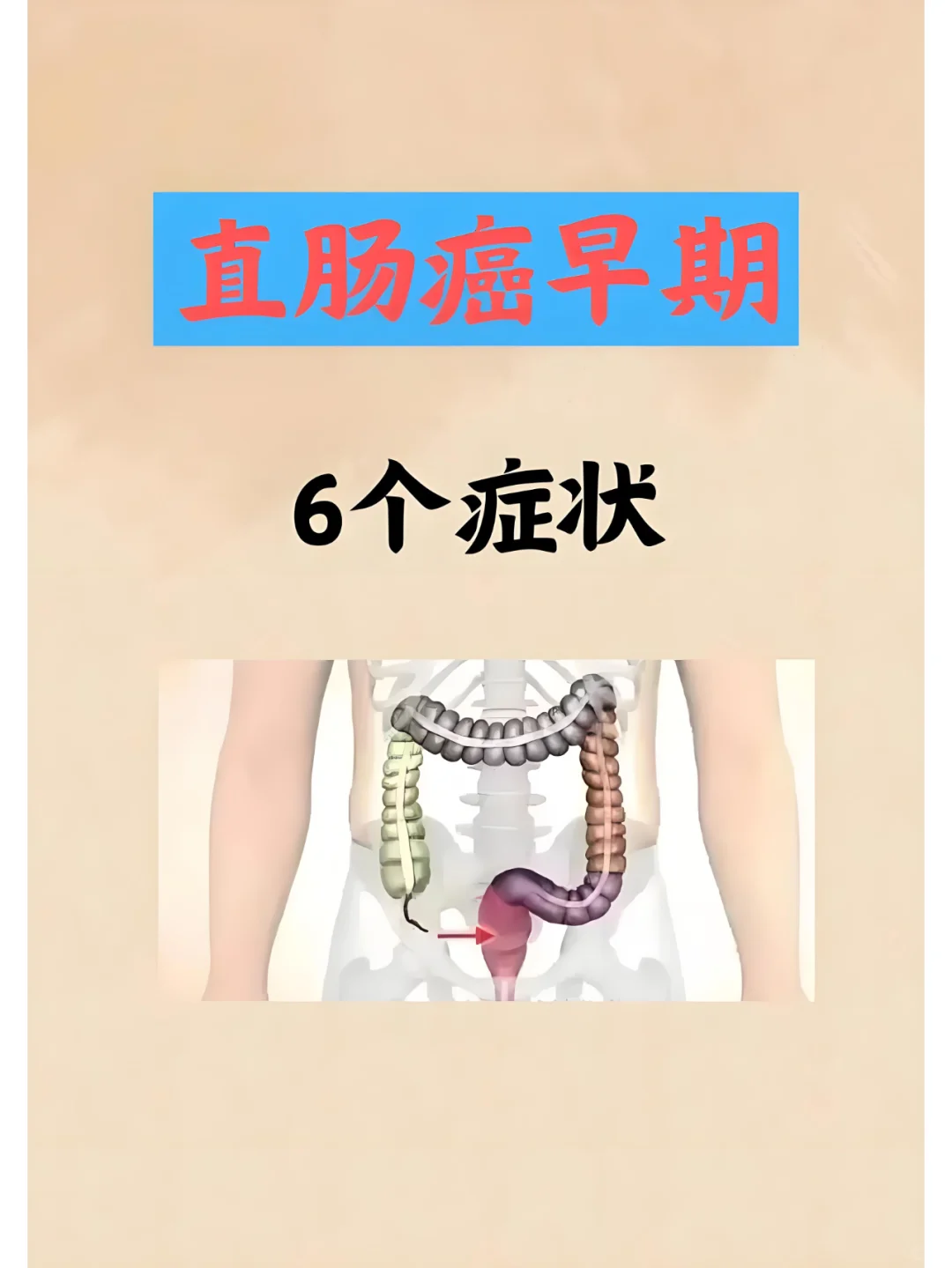 直肠癌早期6个症状一定要警惕！