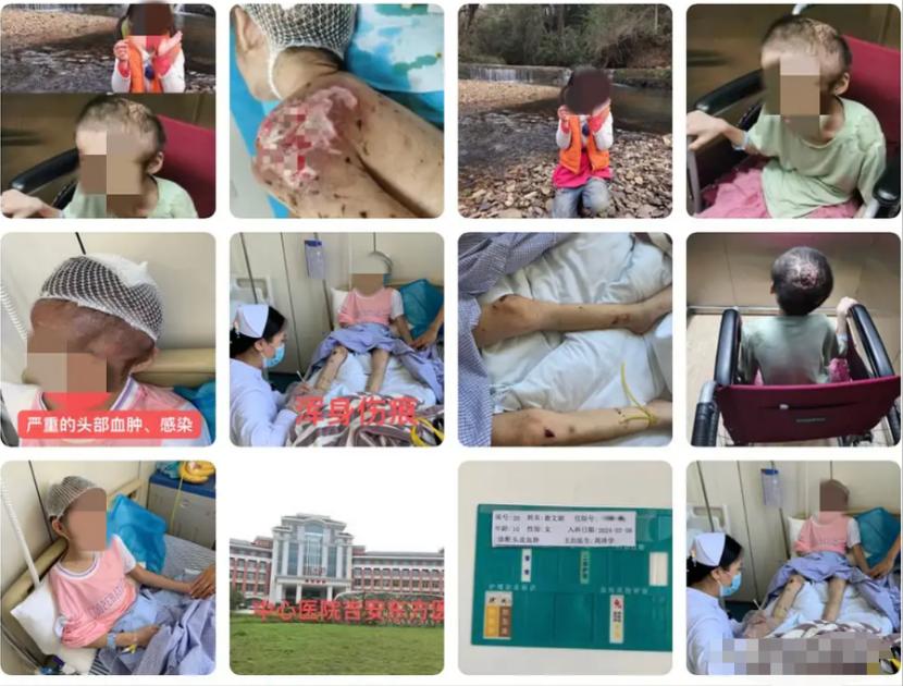 “太狠毒了！”江西吉安，一小女孩被爷爷紧急送到医院，接诊医生看到女孩的伤后，立即