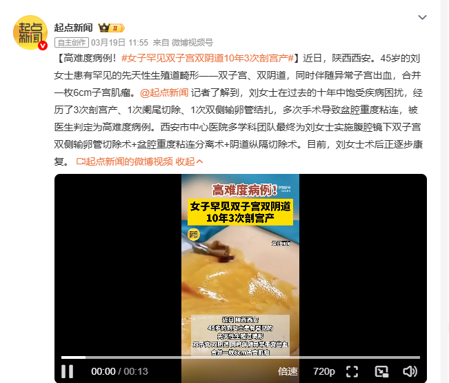 女子罕见双子宫双阴道10年3次剖宫产 45岁刘女士身患罕见先天性生殖道畸形，双子