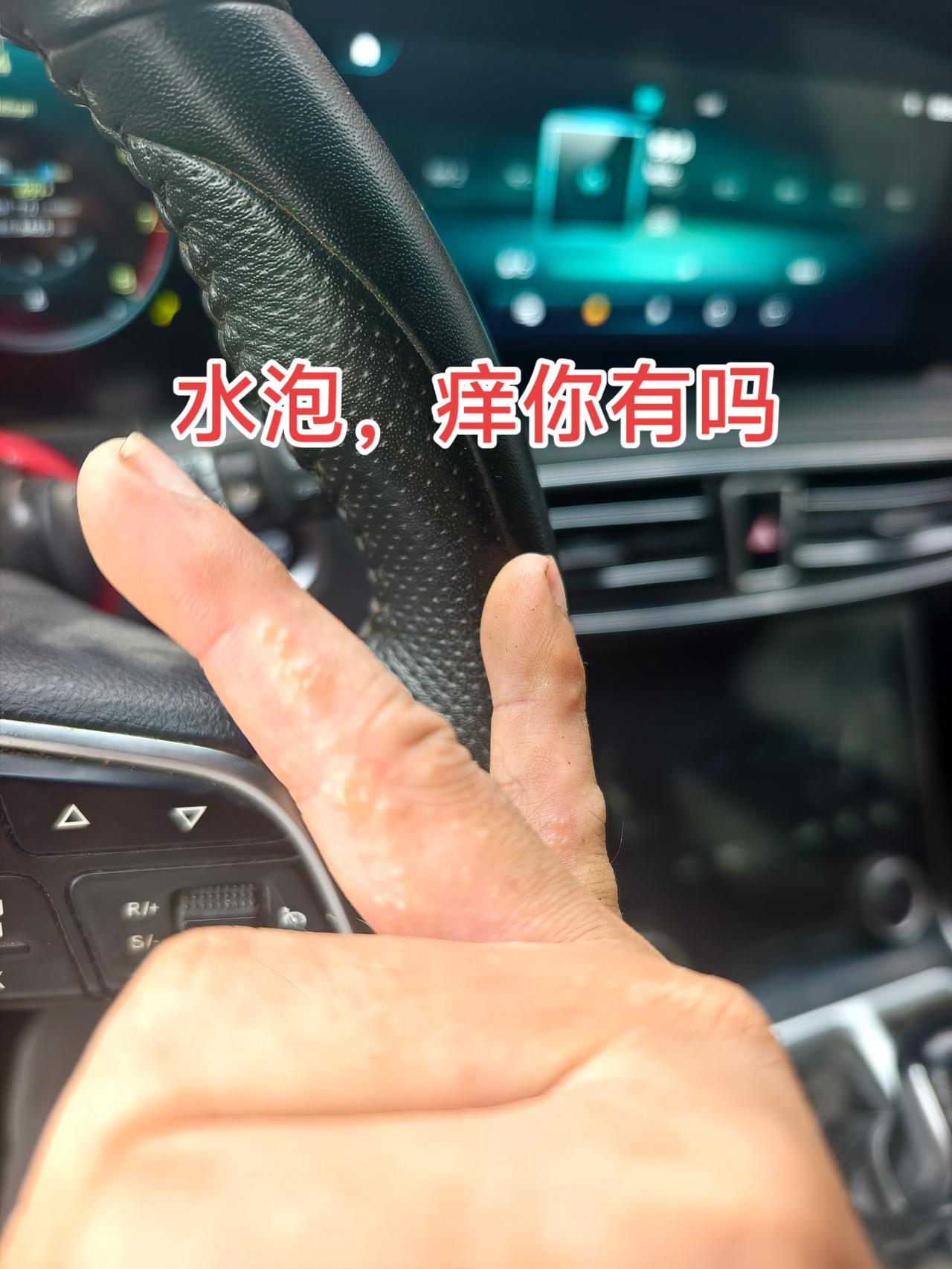 手上长小水泡，钻心的痒，你有吗？到夏天，只要饮料喝多了或者西瓜吃多了，手上就长血
