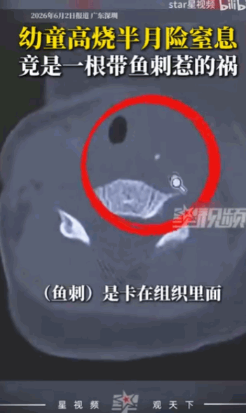"太危险了！" 深圳一个宝宝莫名高烧半个月，脖子肿得不敢动，夜里睡着睡着就开始打
