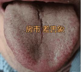 真是少见，这种舌象晚上还不加节制。
 
再这样下去肾亏会更严重，房市还是停一停吧