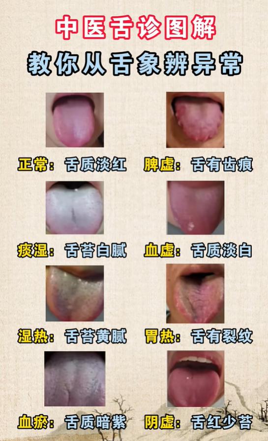 脾虚湿热阴虚各有舌象特征，看懂舌头，循序渐进调理海绵体
