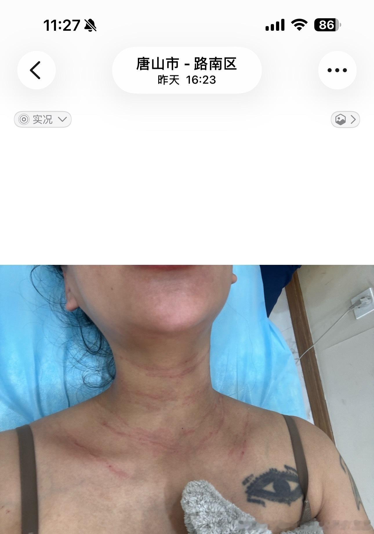 昨天下午四点多打得嗨体 今天恢复差不多了 明天就完全恢复了这个就是浅表注射 大家