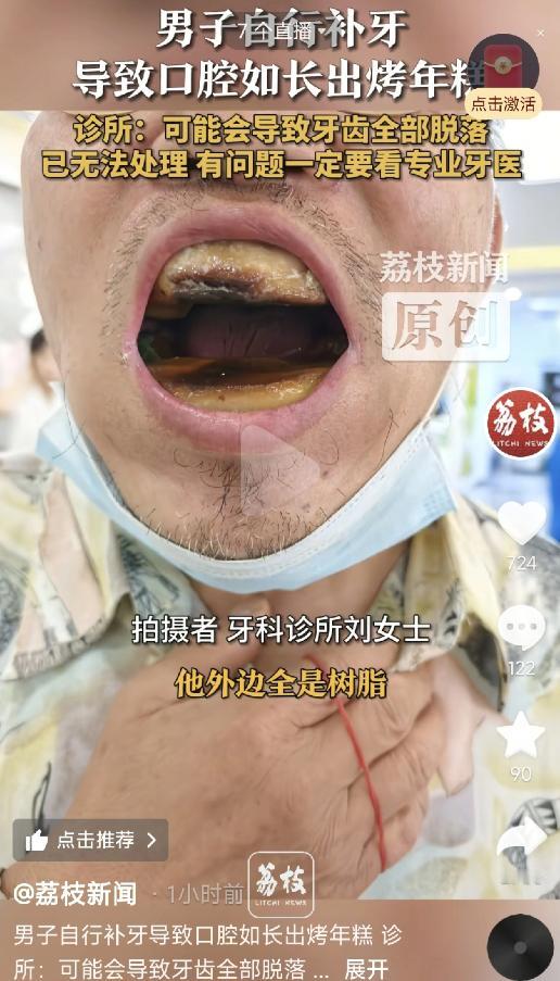 天津，一男子到牙科诊所拔牙，不料，一张嘴吓得医生后退两步，只见到如年糕似的牙床，